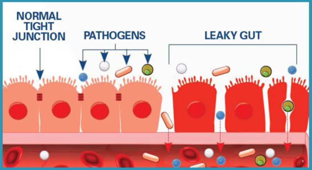 HEALING LEAKY GUT NATURALLY